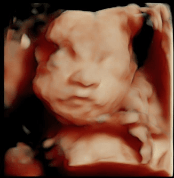 Example of a cropped ultrasound scan showing only the baby