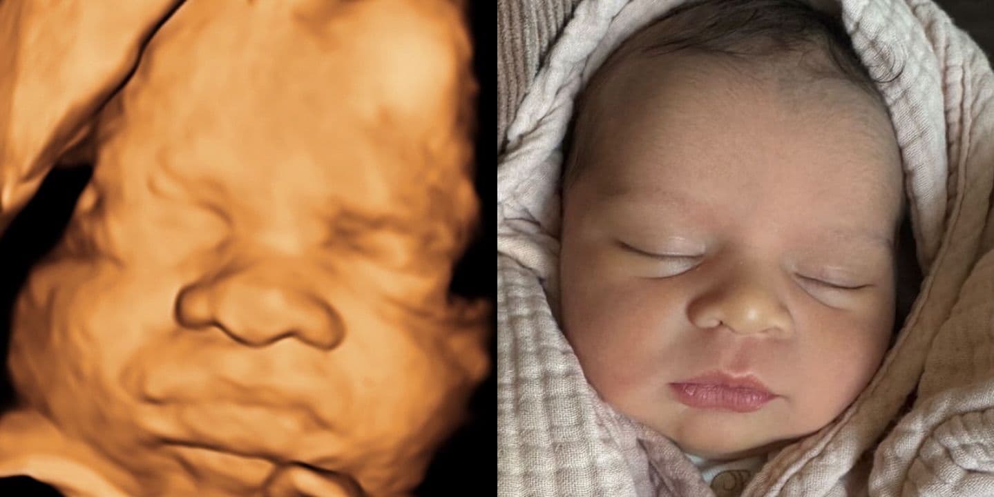 3D ultrasound showing a wide nose next to a photo of the same baby after birth with a normal-sized nose