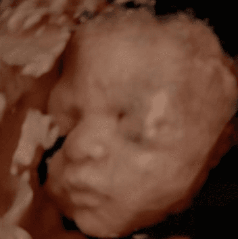 3D Ultrasound