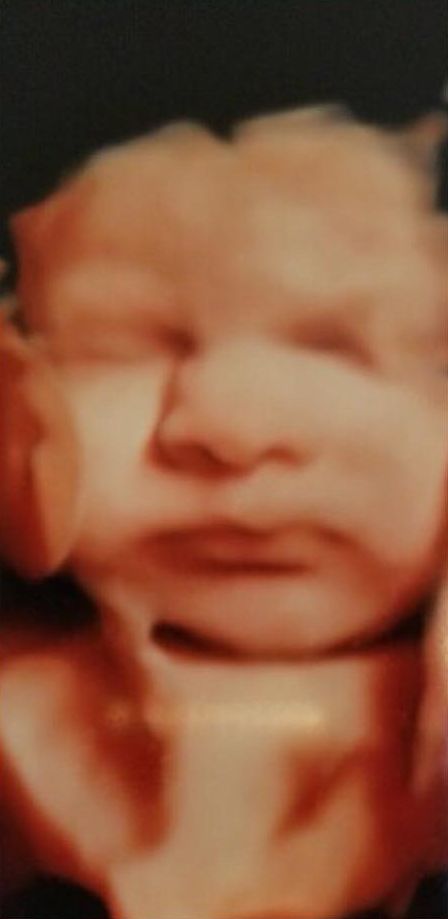 3D ultrasound — Source scan from the studio